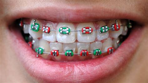 best color combinations for braces.